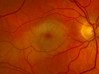 Hollenhorst plaque with branch retinal artery occlusion causing a cherry red spot