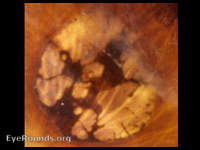 Congenital Hypertrophy of the Retinal Pigment Epithelium = CHRPE lesions