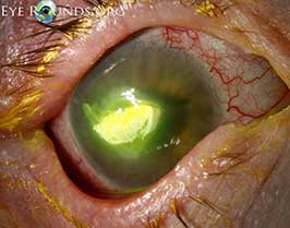 Corneal deposits due to ciprofloxacin eye drops