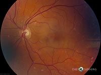 Hollenhorst plaque in Branch Retinal Artery Occlusion