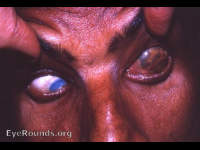 Staphyloma: huge anterior scleral staphyloma
