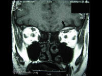subperiosteal hematoma