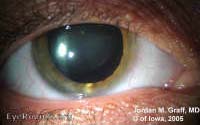 Marfan's Syndrome