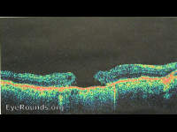 full-thickness macular hole