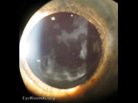 posterior capsular opacity (PCO) following cataract surgery