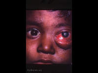 Retinoblastoma, extreme, advanced