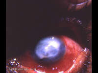 leukomatous cornea with positive Seidel sign with fluorescein