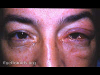 acute angular meibomitis (meibomianitis