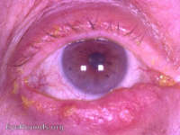 carcinoma of lid margin