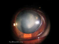 congenital lamellar / zonular cataract
