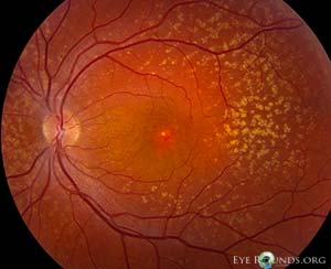 Cuticular drusen