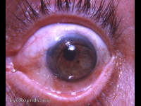 Intracapsular cataract extraction with cystoid cictrix and a corneal contact lens