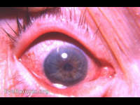 secondary glaucoma simulating acute primary narrow angle glaucoma