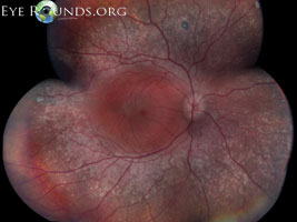 Enhanced S-cone Syndrome