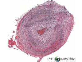Giant Cell Arteritis