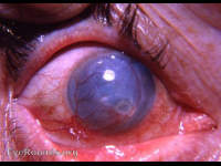 metaherpetic keratitis