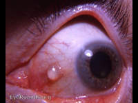 epithelial inclusion cyst
