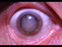 intumescent cataract