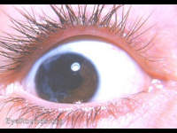 iris atrophy following traumatic hyphema