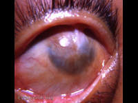 lime burn of the eye
