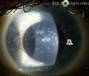macular corneal dystrophy