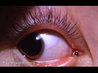 pigmented nevus of caruncle