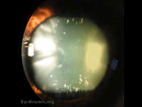 Cataract with refractile bodies