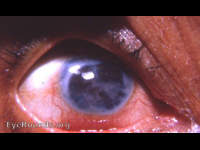 tattooed leukomatous cornea in an eye that is going into phthisis bulbi following unsuccessful cataract surgery