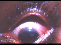 trachoma, typical pannus