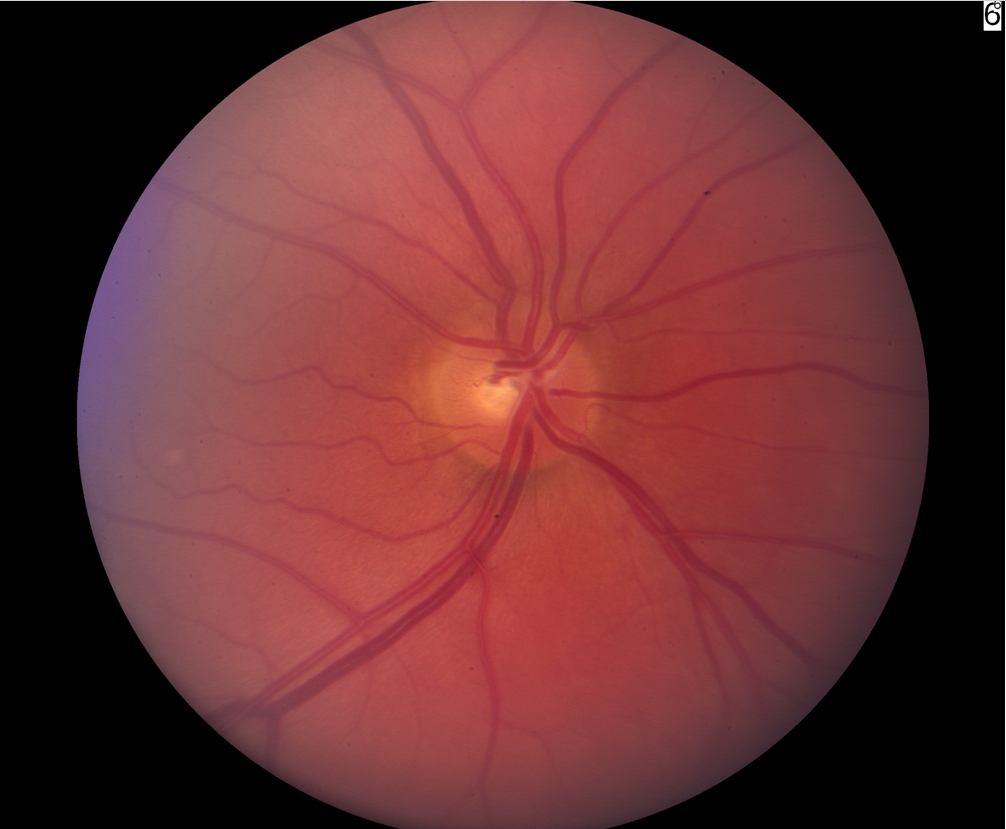 Ch 1 Glaucoma Optic Nerve Disease A Patients Guide To Glaucoma