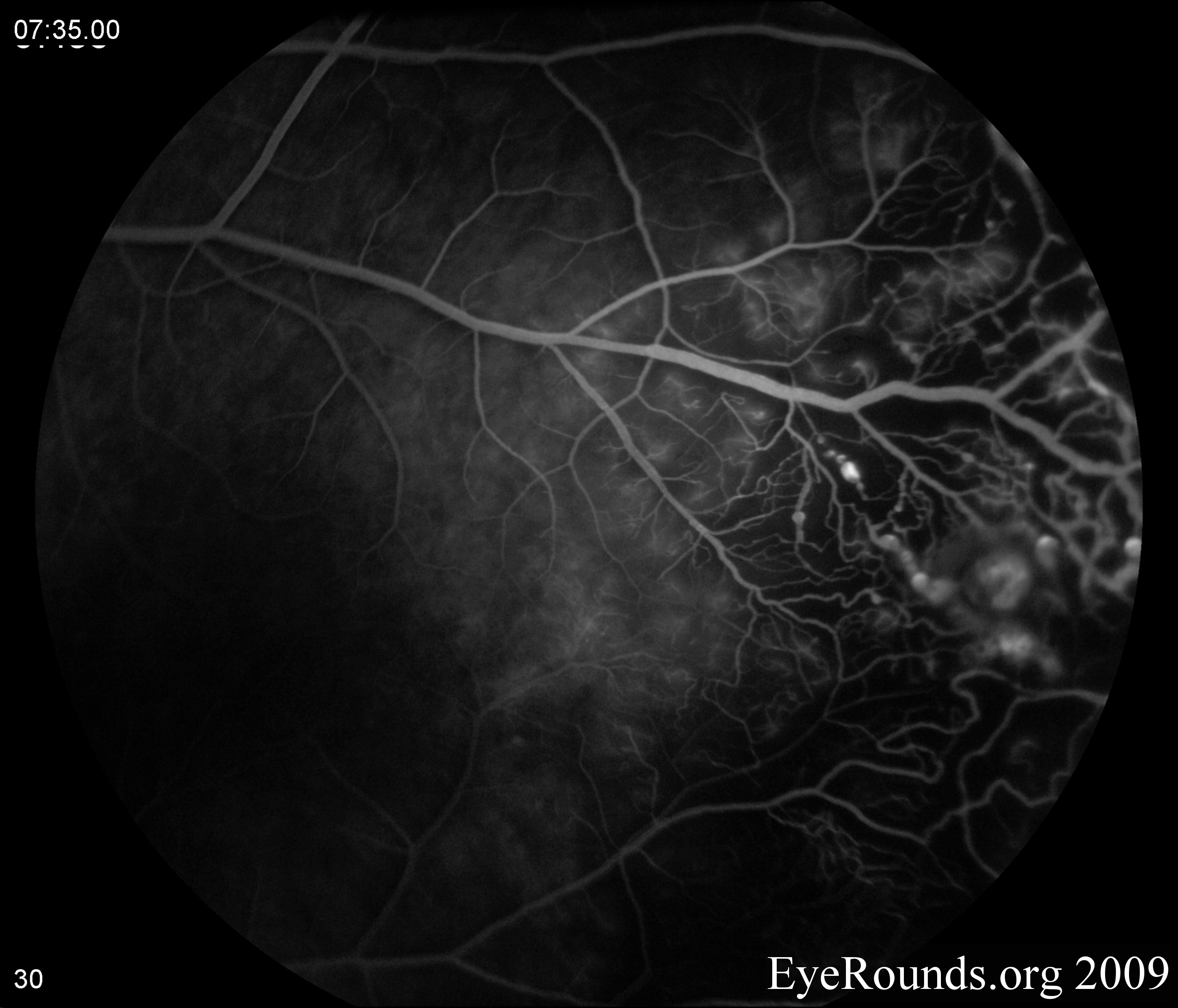 Coats Disease. EyeRounds.org - Ophthalmology - The University of Iowa
