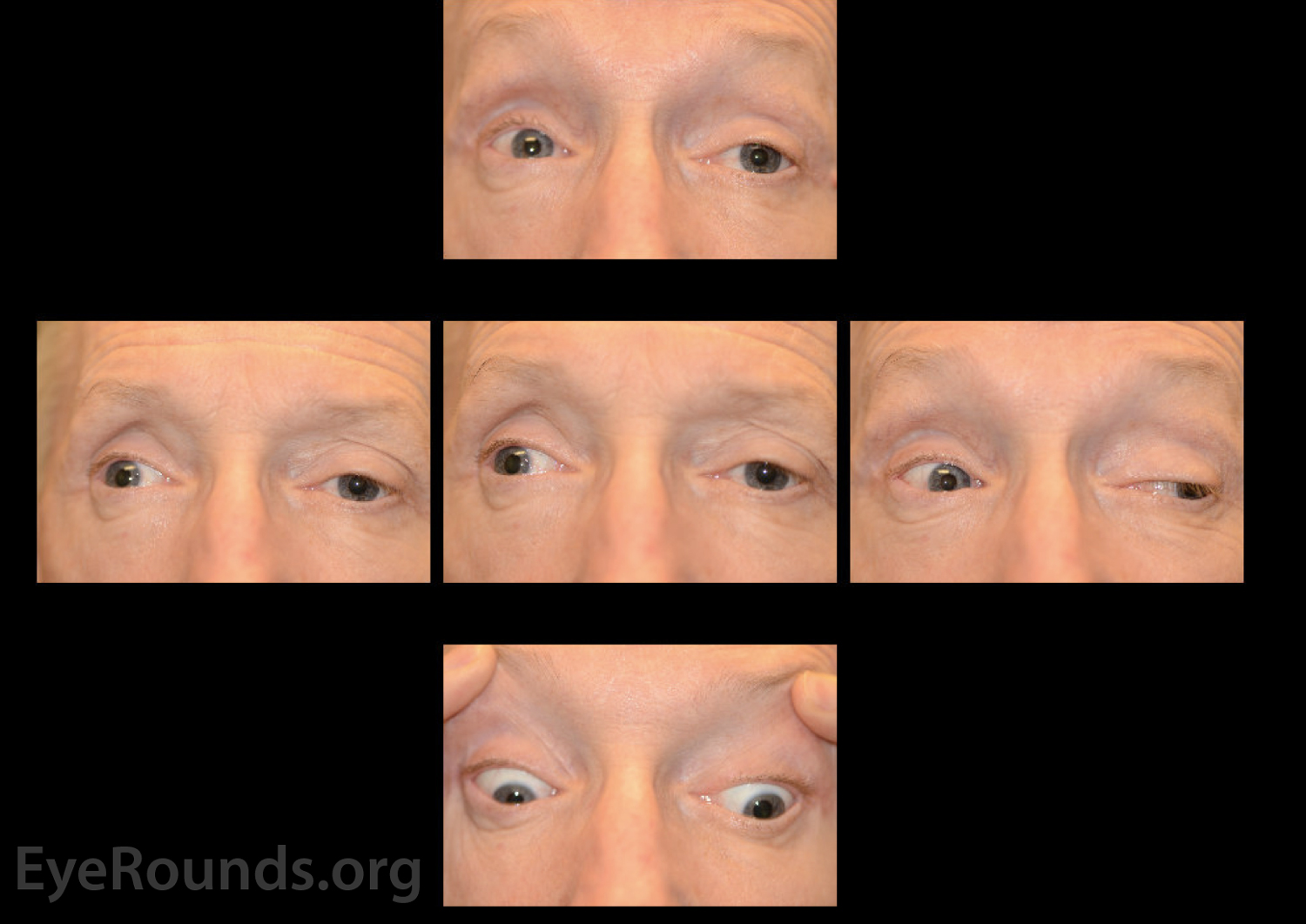 Carotid Cavernous Fistula