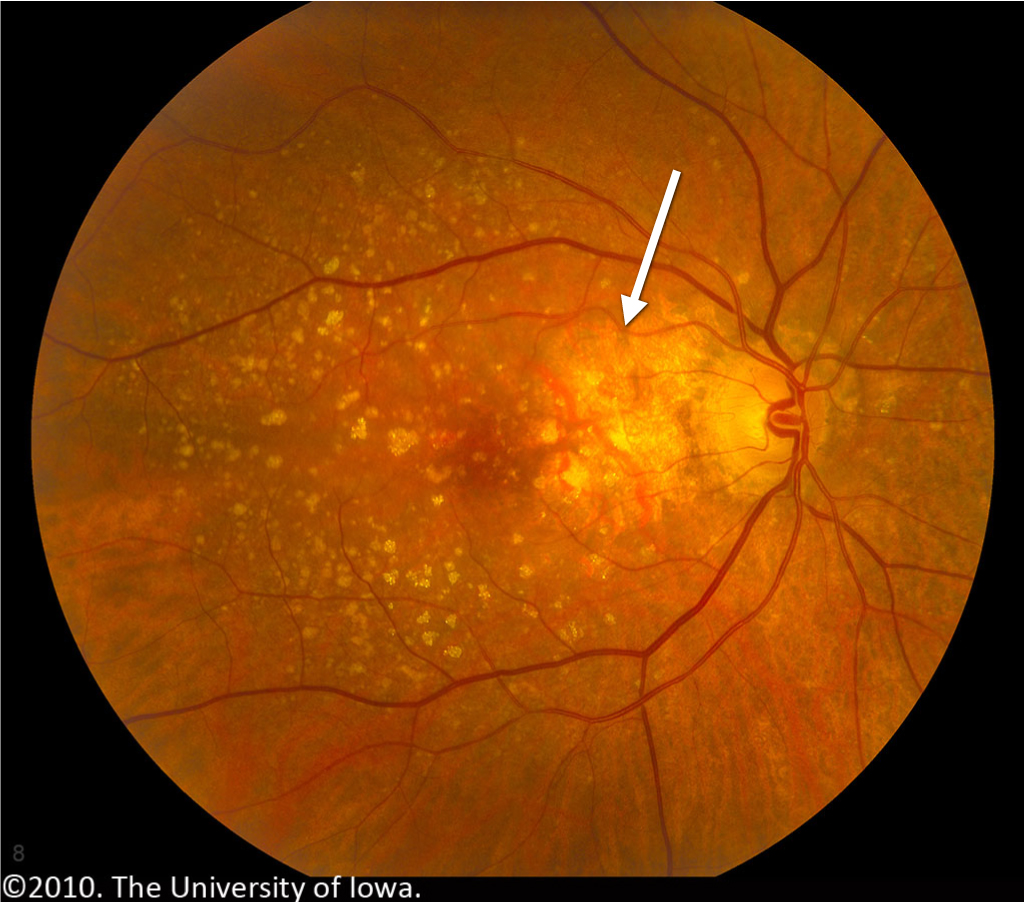 Age-related Macular Degeneration: Progression from ...