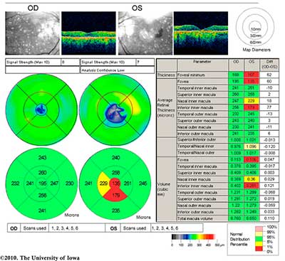 Optical coherence tomography