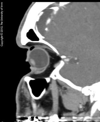 CT scan, sagittal view, demonstrating the upward bowing of the orbital roof and air entrapment under the upper eyelid 