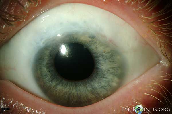 Slit lamp photo of left eye, details in caption