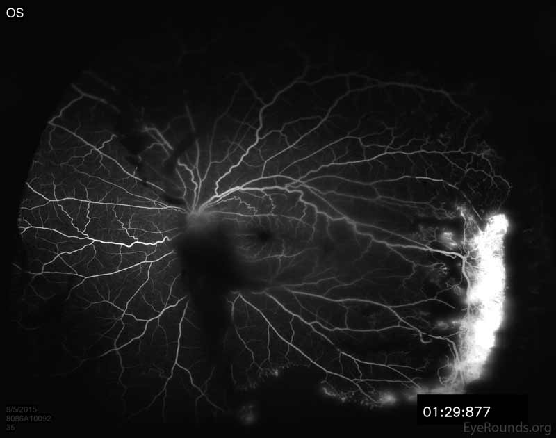 Fluorescein angiogram of the left eye showing hypofluorescence over the disc and macula from overlying vitreous hemorrhage. Note the late leakage from NVE in the superior retina. There is also marked late leakage inferotemporally associated with the NVE and a tractional membrane with adjacent peripheral capillary non-perfusion is visible in the nasal and temporal periphery. 