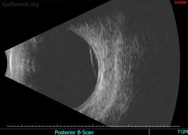 Figure 4B: A membrane, or hyper-reflective layer, is noted in the superior vitreous at 12:00 o'clock near the equator. 