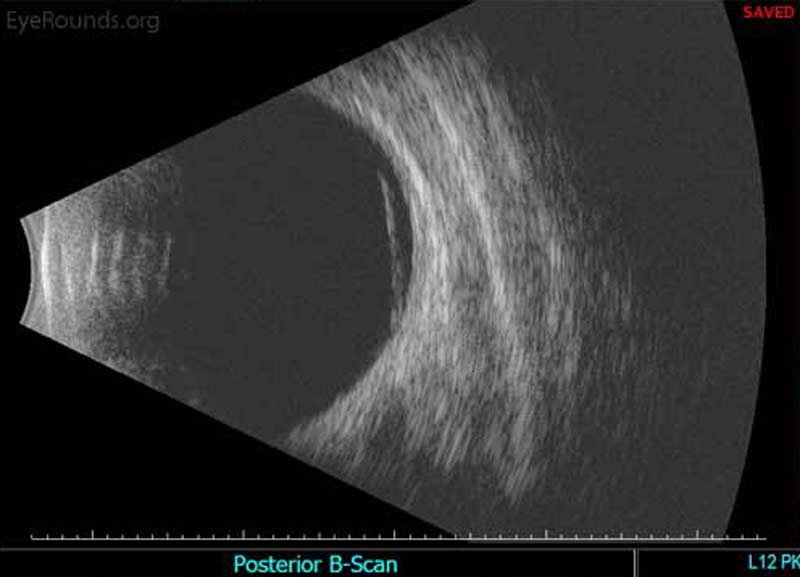 Figure 4B: A membrane, or hyper-reflective layer, is noted in the superior vitreous at 12:00 o'clock near the equator. 