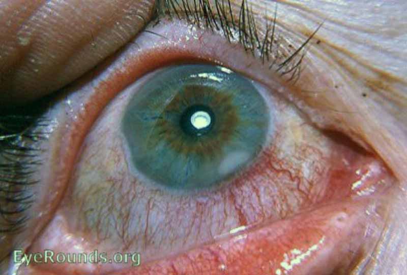 Marginal Keratitis. The corneal infiltrates seen in these photographs are active as evident by the hyperemia adjacent to the corresponding limbal area and the slit-lamp findings of an active keratitis.