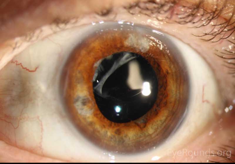 Figure 2: Slit lamp photographs (A, B, and C) showing superior dislocation of a 3-piece posterior chamber intraocular lens within the capsular bag. Capsular phimosis is most notable superonasally in A and B. Retroillumination is used in C to show the dislocated lens, iris atrophy, and intraocular cilium at 6 o'clock. Also evident is the posterior capsule opacification.