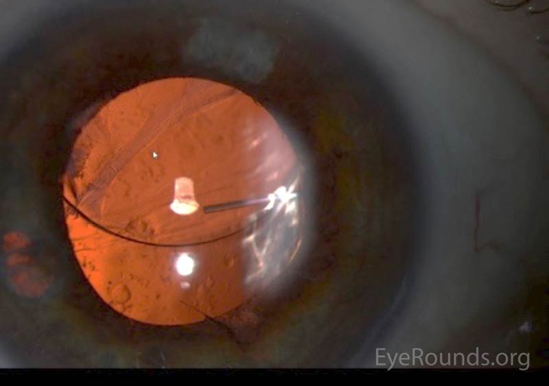 Figure 2: Slit lamp photographs (A, B, and C) showing superior dislocation of a 3-piece posterior chamber intraocular lens within the capsular bag. Capsular phimosis is most notable superonasally in A and B. Retroillumination is used in C to show the dislocated lens, iris atrophy, and intraocular cilium at 6 o'clock. Also evident is the posterior capsule opacification.