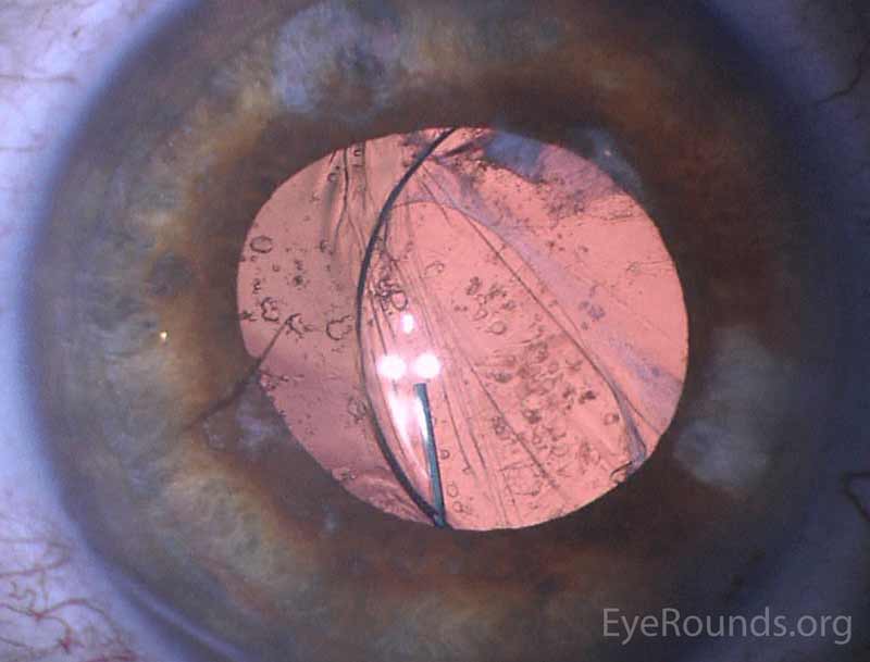 Figure 3: Preoperative (3A) and intraoperative (3B) imaging showing removal of intraocular cilium with duet forceps.  (please see: Intraocular cilium removal following trauma)