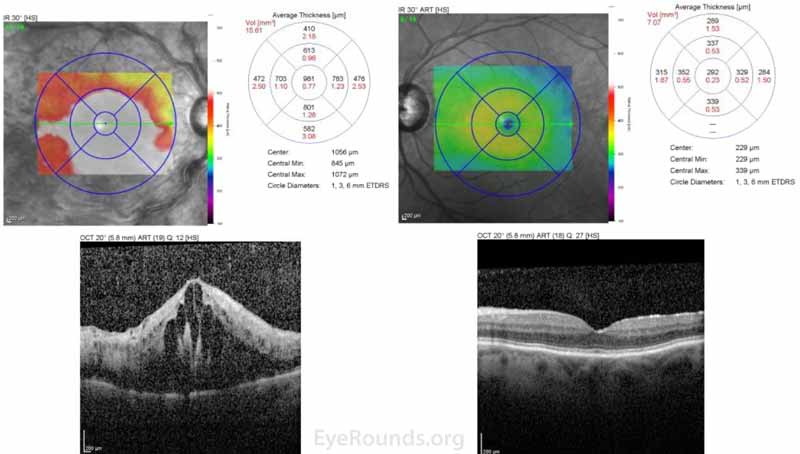 Optical coherence tomography (OCT), both eyes: OD - Severe cystoid macula edema (CME) with a central macula thickness of 981 microns. OS -  Normal foveal contour with mild epiretinal membrane.