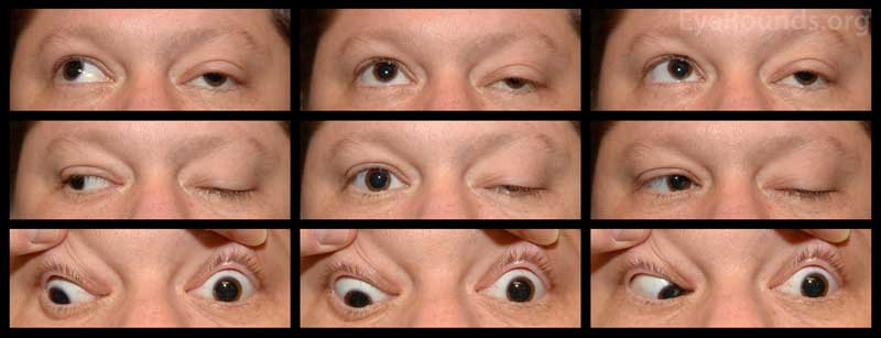 Nine gaze photos show left exotropia (10 PD) with a left hypotropia (25 PD) in primary gaze. Motility exam demonstrates a -3.5 gaze restriction in all cardinal gazes OS.