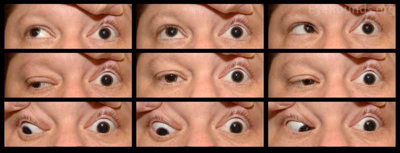 Nine gaze photos show left exotropia (10 PD) with a left hypotropia (25 PD) in primary gaze. Motility exam demonstrates a -3.5 gaze restriction in all cardinal gazes OS.