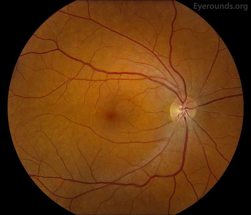 Fundus photos shows mild torsion of left eye (right image), otherwise normal in both eyes.