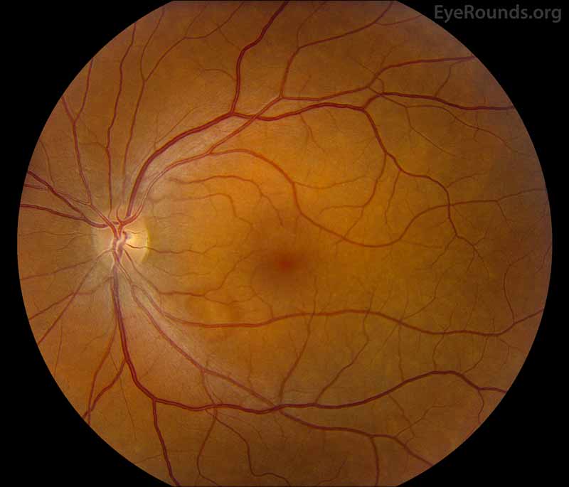 Fundus photos shows mild torsion of left eye (right image), otherwise normal in both eyes.