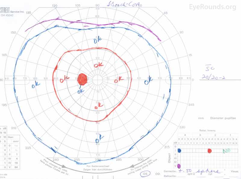 Goldmann kinetic perimetry of both eyes. OD: Full with a relative scotoma to the I2e isopter temporal to the blindspot. OS: Loss of the I1e isopter, otherwise full.