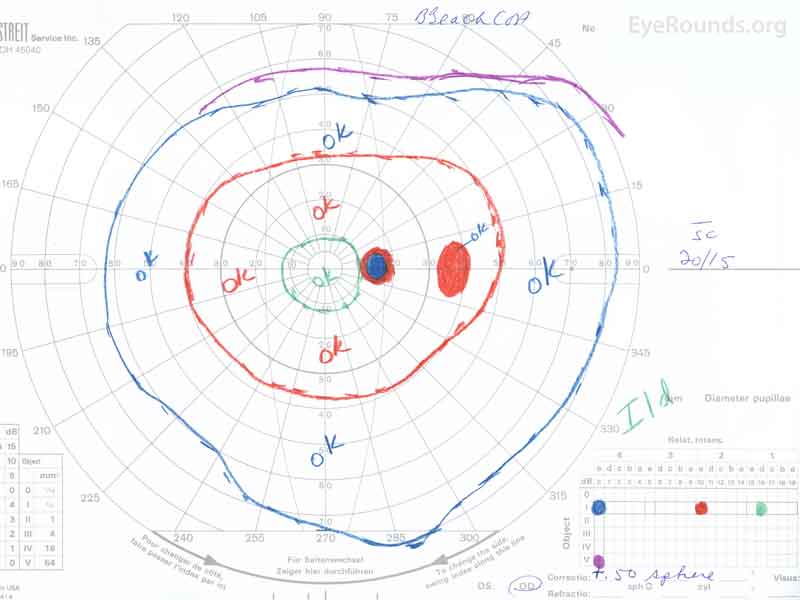 Goldmann kinetic perimetry of both eyes. OD: Full with a relative scotoma to the I2e isopter temporal to the blindspot. OS: Loss of the I1e isopter, otherwise full.